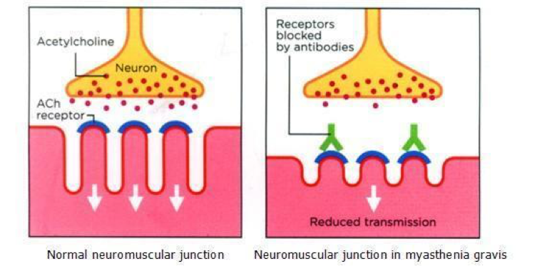 acetylcholine receptor myasthenia gravis